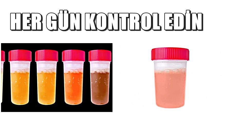 İdrarınız bu renkse derhal doktora gidin 1
