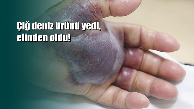 Çiğ deniz ürünü yedi, elinden oldu 1