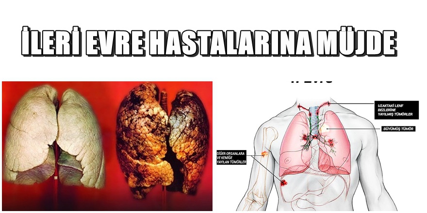 Akciğer Kanseri 4. Evre tedavisinde müjdeli haber 1