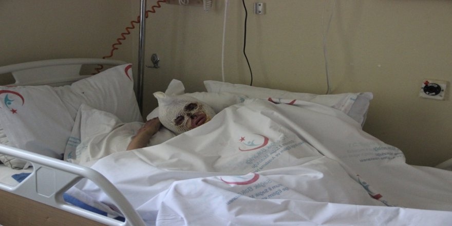 Tüp Patlaması Sonucu Yanan Kadın 2 Aydır İyileşeceği Günü Bekliyor