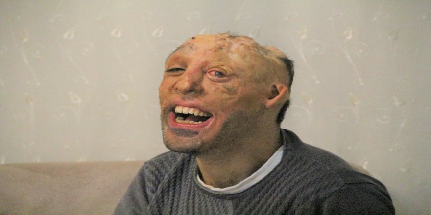Vücudu Yanan Mehmet Ali’nin Dramı